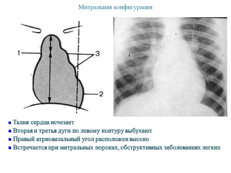 Митральная конфигурация  Талия сердца исчезает  Вторая и третья дуги по левому контуру